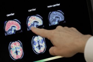 La maladie d'Alzheimer est la forme la plus courante de démence sénile (archives). KEYSTONE/AP/MATT YORK